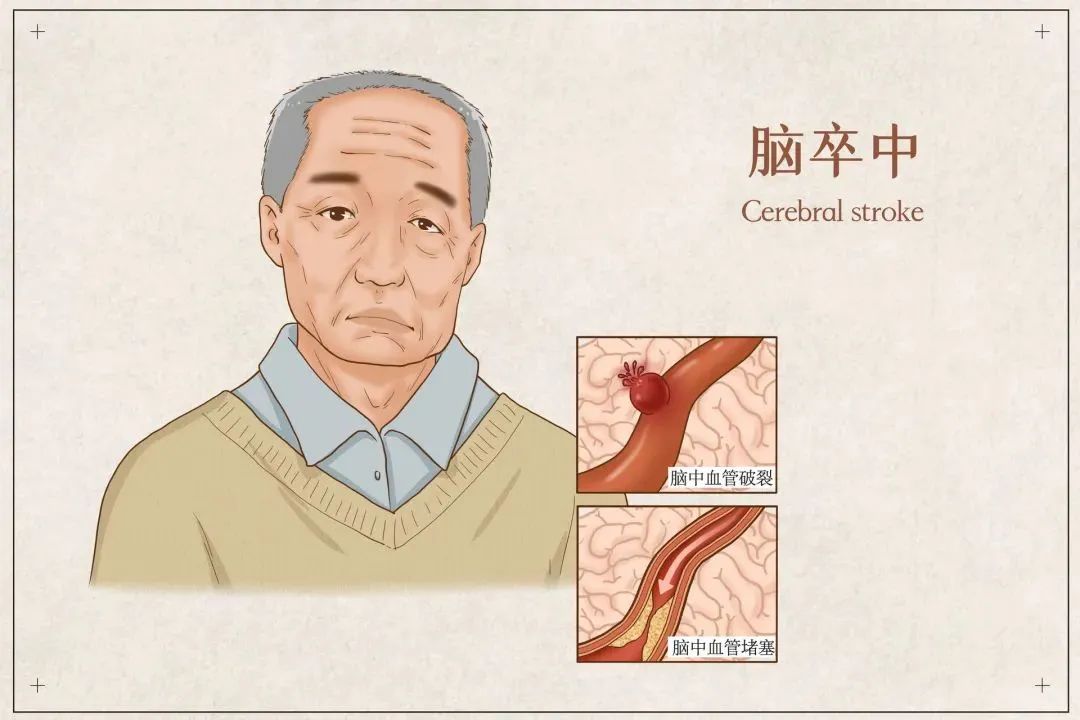 全國高血壓日丨血壓高了，會(huì)損傷這幾個(gè)器官，如何預(yù)防(圖5)