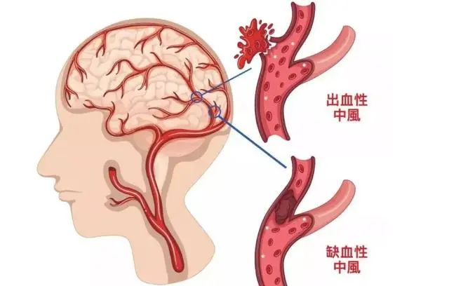 為什么中國腦梗越來越多，美國卻在減少？醫(yī)生：主要原因有這3點(圖1)