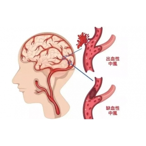 為什么中國腦梗越來越多，美國卻在減少？醫(yī)生：主要原因有這3點